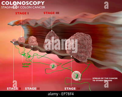 Fasi di cancro al colon su sfondo rosso Foto Stock