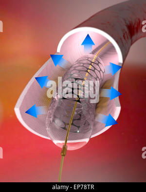 Arteria e uno stent all'interno di esso. Foto Stock