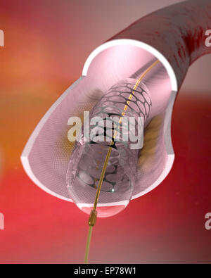 Arteria e uno stent all'interno di esso. Foto Stock