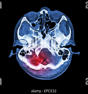 Le lesioni cerebrali, Corsa : ( CT scan del cervello e la base del cranio ) ( finestra ossea ) Foto Stock