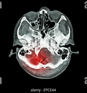 Le lesioni cerebrali, Corsa : ( CT scan del cervello e la base del cranio ) ( finestra ossea ) Foto Stock