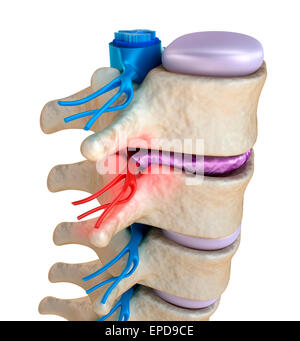 Il midollo spinale sotto pressione di rigonfiamento disc Foto Stock