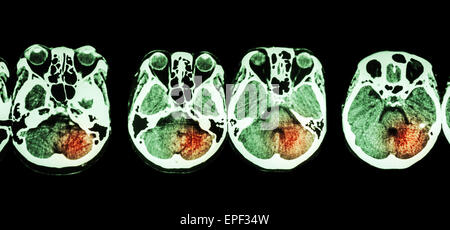 Tempi ( CT scan del cervello e la base del cranio e corsa ) Foto Stock