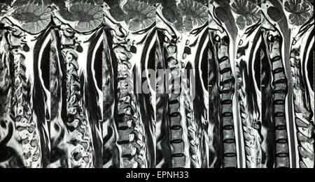 Spondilosi cervicale con formazione di ernia al disco ( MRI della colonna cervicale : mostra spondilosi cervicale con ernia discale comprimere spin Foto Stock