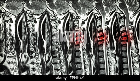 Spondilosi cervicale con formazione di ernia al disco ( MRI della colonna cervicale : mostra spondilosi cervicale con ernia discale comprimere spin Foto Stock