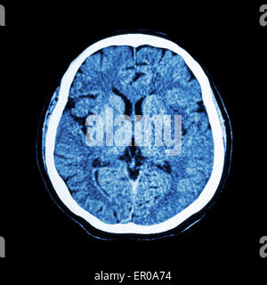 Scansione TC del cervello : mostra normali di uomo 's cervello ( CAT scan ) Foto Stock