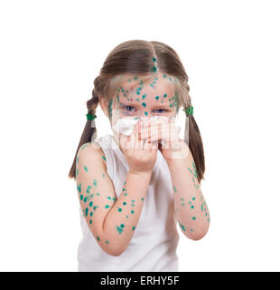 Acnes sul bambino. la varicella Foto Stock