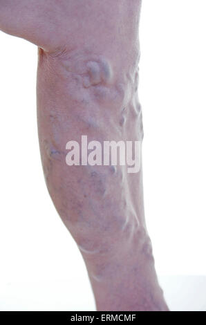 Vene varicose gamba (femmine, età 68 anni) / Krampfadern Varizen am Bein (Frau, Alter 68 Jahre) Foto Stock