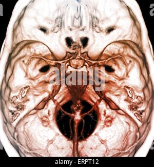 Le arterie del cervello. 3D la tomografia computerizzata (CT) scansione angio di arterie normale nel cervello di un 38 anno di età. Foto Stock