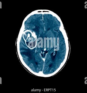 Colorato la tomografia computerizzata (CT) scansione del cervello di un 58 anno vecchio paziente che ha avuto un aneurisma (al centro a sinistra) nell'arteria cerebrale media. Un aneurisma è un sangue-riempito la dilatazione in un vaso sanguigno. Essa è causata da un indebolimento della parete del vaso, WH Foto Stock