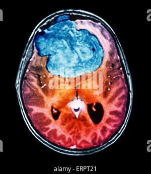 Benigna tumore al cervello. Colorato la tomografia computerizzata (CT) scansione del cervello di un 25 anno di età di un paziente con un meningioma (blu). Si tratta di un benigno (non cancerosi) il tumore che nasce dalla meningi, le membrane che circondano il cervello. È stato causato da radi Foto Stock