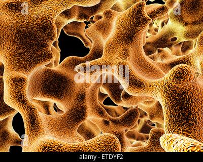 L'osteoporosi. Computer grafica delle trabecole nel spugnoso spugnoso () tessuto osseo interessato da osteoporosi. Il tessuto spugnoso riempie la parte interna delle ossa e osteoporosi la sua densità diminuisce aumentando la fragilità delle ossa e Foto Stock