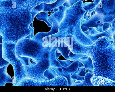 L'osteoporosi. Computer grafica delle trabecole nel spugnoso spugnoso () tessuto osseo interessato da osteoporosi. Il tessuto spugnoso riempie la parte interna delle ossa e osteoporosi la sua densità diminuisce aumentando la fragilità delle ossa e Foto Stock