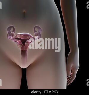 Sezione illustrazione che mostra i fibroidi uterini, tumori benigni in utero. Foto Stock