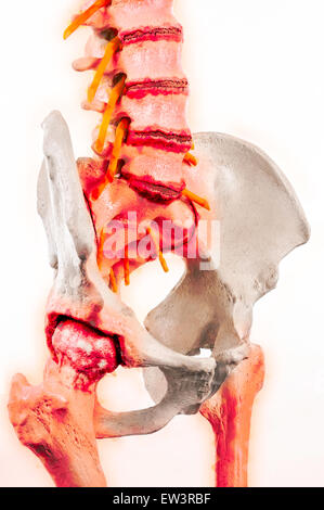 Grafico illustrativo della spondilite anchilosante - una forma degenerativa di artrite che colpisce la colonna vertebrale e articolazioni sacroiliac Foto Stock