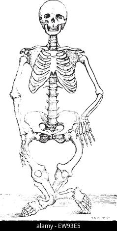 Lo scheletro deformato da rachitismo, vintage illustrazioni incise. Al solito Dizionario medicina dal dr. Labarthe - 1885. Illustrazione Vettoriale