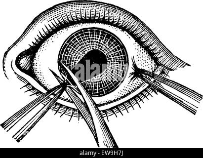 Iridectomia, pinze che mostra la rimozione di un lembo dell'iride, vintage illustrazioni incise. Al solito Dizionario medicina dal dr. Labarthe Illustrazione Vettoriale