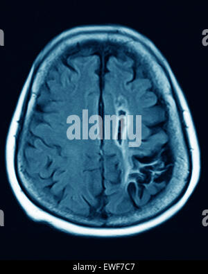 Atrofia cerebrale, MRI Foto Stock