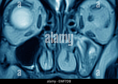 MRI DI SINUSITE Foto Stock