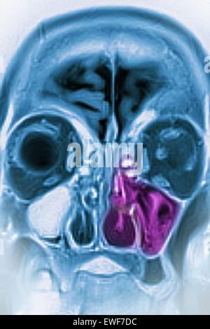 MRI DI SINUSITE Foto Stock