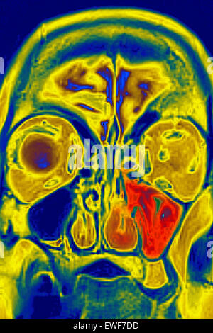 MRI DI SINUSITE Foto Stock