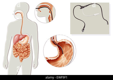 Gastroscopia, illustrazione Foto Stock