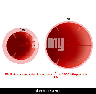 Aneurisma della pressione del sangue Foto Stock