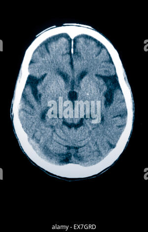 Scansione TC di un 84 anno vecchio con il morbo di Alzheimer. CT mostra atrofia cerebrale. Foto Stock
