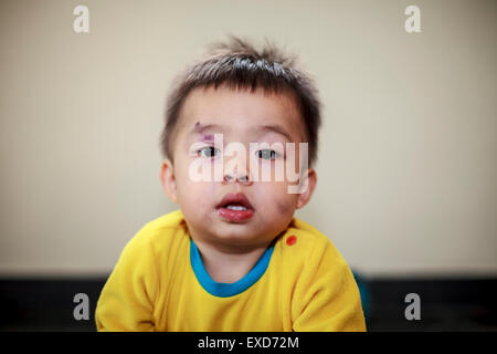 Un bambino con un occhio nero e ammaccature sul suo volto Foto Stock