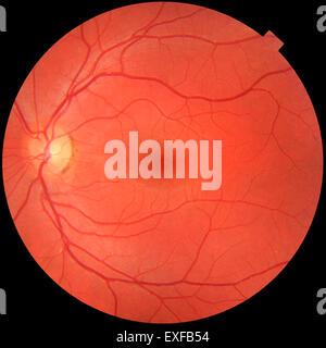 Fotografia del fundus di normale occhio sinistro. La macula in pieno centro a disco ottico in cui i vasi sanguigni sono convergenti, pigmentazione sul perimetro Foto Stock