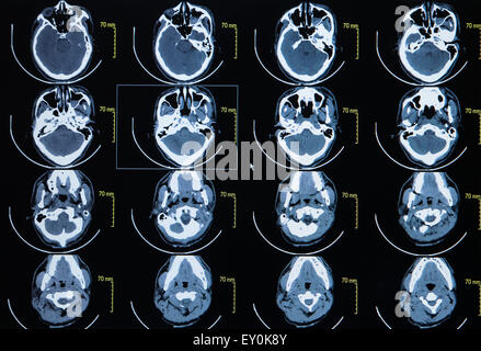 La serie di immagini da una tomografia computerizzata del cervello Foto Stock