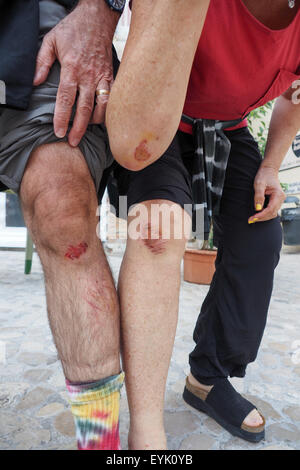 Un giovane che mostra le loro escursioni in bicicletta le ferite; pascolato del gomito e del ginocchio, Foto Stock