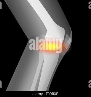 Artrite in ginocchio, il dolore del ginocchio, che soffrono di ginocchio, vettore Illustrazione Vettoriale