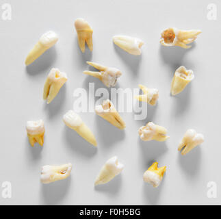 Root remoto denti umani Foto Stock