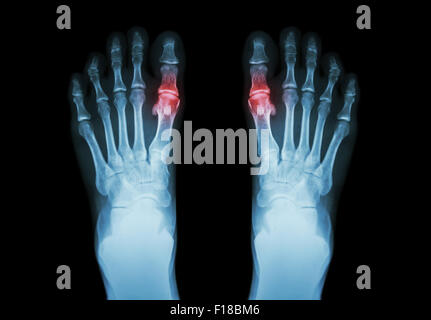 Gotta , Artrite reumatoide ( Film x-ray entrambi i piedi e artrite al primo giunto metatarsophalangeal ) ( la medicina e la scienza bac Foto Stock