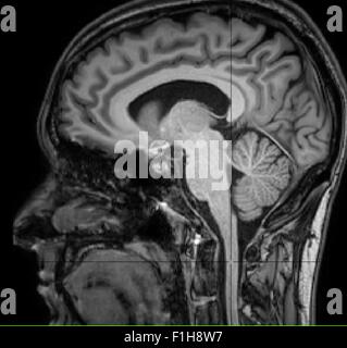 Vista sagittale del cervello e del midollo spinale su un'immagine T1 Foto Stock