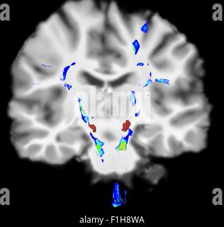 Vista coronale del cervello umano il morbo di Parkinson. Blu/aree verdi evidenziare fibre sistema motore zona rossa è substancia nigra Foto Stock