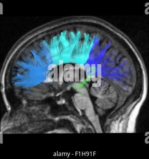 Vista laterale del corpo calloso fibre. La più grande struttura di connessione sinistra e emisfero destro Foto Stock