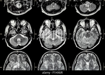 MRI del cervello ( sezione del cervello ) ( medico , Health care , Scienza background ) Foto Stock