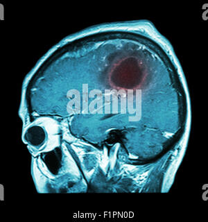 Film MRI del cervello con tumore al cervello ( piano sagittale , vista laterale , vista laterale ) ( medico , Health care , Scienza Background ) Foto Stock
