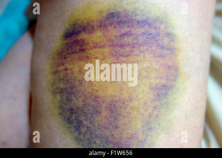 Un grande inchino, contusione o ematoma su una donna è la gamba o la pelle della coscia mostra nero, blu e giallo lo scolorimento Foto Stock