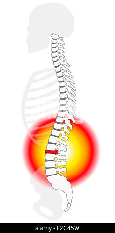 Spinale ernia del disco o il prolasso a un essere umano la colonna vertebrale - vista di profilo. Foto Stock