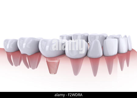 A denti e impianto dentale 3D render Foto Stock
