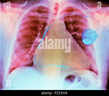 Pacemaker nella malattia di cuore. Colorato i raggi X al torace che mostra un pacemaker (destra) montato su un 73-anno-vecchio paziente di sesso maschile con un ingrandimento di un cuore (cardiomegaly) di fibrillazione atriale, malattia cardiaca ischemica e malattia polmonare ostruttiva cronica (COPD). Un pacemaker fornisce impulsi elettrici al cuore per mantenere il battito cardiaco a un ritmo regolare. Esso può essere esterna (indossato su una cintura) o interno (impiantato nel petto, come qui). Foto Stock