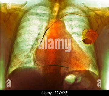 Pacemaker nella malattia di cuore. Colorato i raggi X al torace che mostra un pacemaker (destra) montato su un 73-anno-vecchio paziente di sesso maschile con un ingrandimento di un cuore (cardiomegaly) di fibrillazione atriale, malattia cardiaca ischemica e malattia polmonare ostruttiva cronica (COPD). Un pacemaker fornisce impulsi elettrici al cuore per mantenere il battito cardiaco a un ritmo regolare. Esso può essere esterna (indossato su una cintura) o interno (impiantato nel petto, come qui). Foto Stock