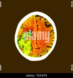 Cervello in corsa. Imaging a risonanza magnetica (MRI) scansione di una sezione assiale attraverso il cervello di un 80-anno-vecchio paziente di sesso maschile a seguito di un ictus. Una corsa, o accidente cerebrovascolare (CVA), è la rapida perdita della funzione cerebrale a causa di un disturbo nel rifornimento di sangue al cervello. Un attacco grave ischemico è causato da una riduzione della fornitura di sangue ad una zona del cervello. Foto Stock