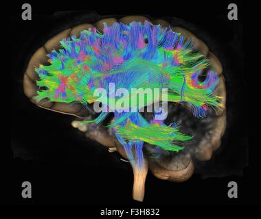 La diffusione MRI, a cui si fa riferimento anche come imaging del tensore di diffusione o DTI, del cervello umano Foto Stock