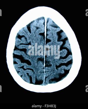 Scansione TC 84 enne maschio con la malattia di Alzheimer. CT mostra atrofia cerebrale con gyri piccoli e grandi sulci Foto Stock