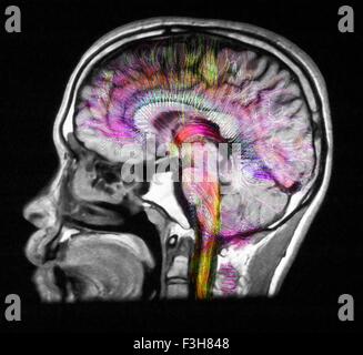 La diffusione MRI, a cui si fa riferimento anche come imaging del tensore di diffusione o DTI, del cervello umano Foto Stock