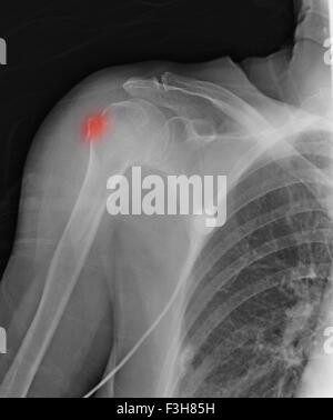 88 enne femmina con Omero superiore la frattura e la storia di osteoporosi Foto Stock